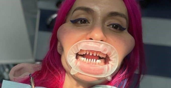 Model met ’s werelds grootste wangen’ toont haar natuurlijke tanden