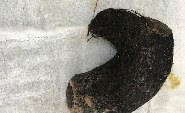 1 PAY Doctors remove HUGE HAIRBALL from five year old girls stomach and it weighs over 3lbs