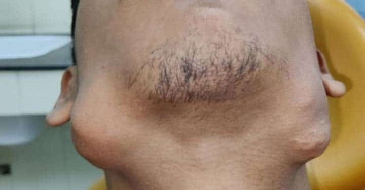 TAND TUMOR