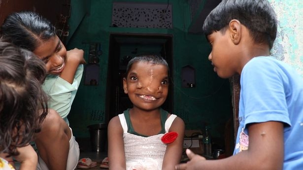0 PAY Girl 6 born with a TRUNK and left with TWO NOSES is local celebrity with fans comparing her to 1