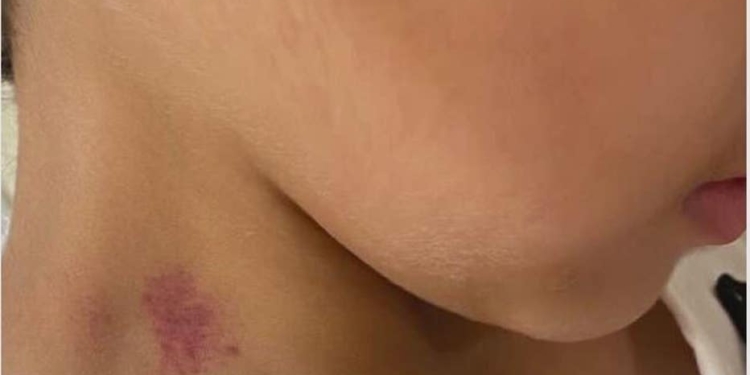 spring hickey incident