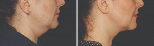 coolsculpting2 | GFC
