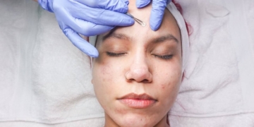 huid puist acne behandeling schoonheid