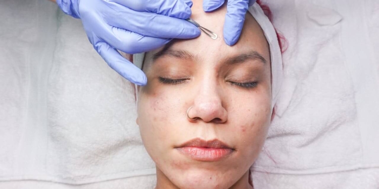 huid puist acne behandeling schoonheid